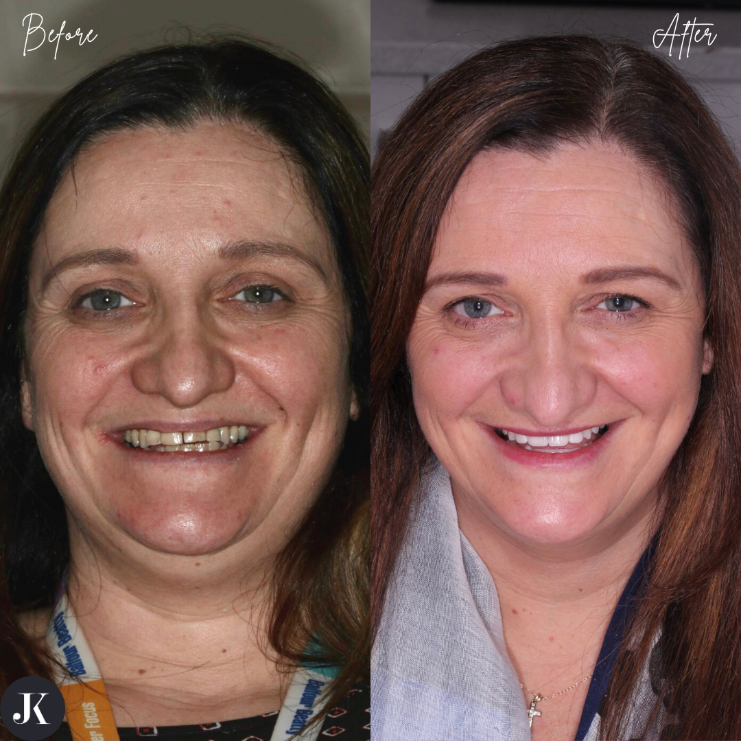 Before and after dental implant treatment with Jamie Kerr